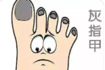 上海治疗灰指甲医院排名-灰指甲怎么才能治疗好