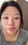 女子割双眼皮致九级伤残 双眼无法闭合 整形悲剧引发广泛关注