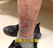 一名男子吸烟50年，把两条腿“吸坏”了，双腿溃烂、满是伤疤，医生：烟草是主要致病因素