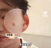 撸铁后挠脸 男子脸上长出“小肉球” 健身卫生需重视