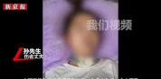 女子被蜱虫咬伤患森林脑炎四肢瘫痪 一场未被重视的风险