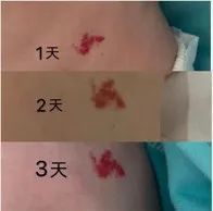 女生曬照被網(wǎng)友看出血管瘤 網(wǎng)友：默默打開手電筒