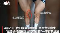 被错切右膝体育生母亲称不接受和解 寻求法庭解答疑惑