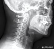 男子中午吃一条鱼 下午上班死亡 小鱼刺引发大悲剧