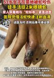53岁阿姨被眼镜蛇咬伤后 徒手擒蛇 冷静自救教科书
