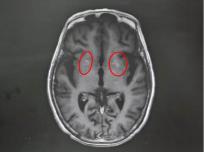 高血糖“烧坏”老人运动功能协调区