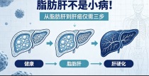 脂肪肝不是小病！从脂肪肝到肝癌，仅需三步，肝胆医生劝你别拖