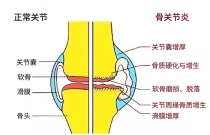 了解硫酸氨基葡萄糖的作用与功效，轻松应对骨关节炎