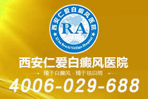重点关注！西安有哪些专看白癜风的医院"特别榜单"哪些部位容易长白癜风