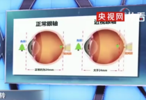 专家:近视手术无法治愈近视 手术无法改变眼球的病变