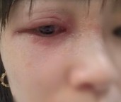 女子捏死隐翅虫后摸脸次日脸部溃烂 隐翅虫险毁容