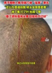 男子路邊抽煙后腦勺被老鷹襲擊：頭劇痛,，已打針，并報警