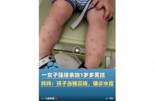 女子強吻男孩致水痘 律師稱或涉及故意傷害 事件引發(fā)法律責(zé)任討論