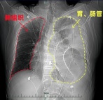 男子体检发现左肺“消失” 40岁惊觉身体异样
