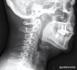 男子中午吃一条鱼 下午上班死亡 小鱼刺引发大悲剧