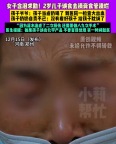 一个动作造成二次损伤！2岁男童误服去污膏肠胃全腐蚀