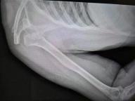 女子在睡梦中粉碎性骨折 癫痫发作所致