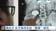 女子不爱喝水长巨型肾结石 罕见病例警示多饮水的重要性