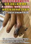 53岁阿姨被眼镜蛇咬伤后 徒手擒蛇 冷静自救教科书