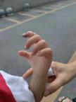 2岁女童手指发紫近36小时险截指 橡皮筋成隐形杀手