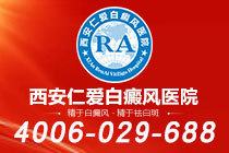 速览！西安专看白癜风的医院在哪"具体排名"白癜风部位发红怎么回事