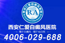 近期发布！西安看白癜风的专科医院有哪些"热度榜单"睡眠不好对白癜风患者有什么影响