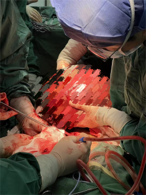 10.4公斤肿瘤破裂医生“拆弹” 多学科协作保肾成功