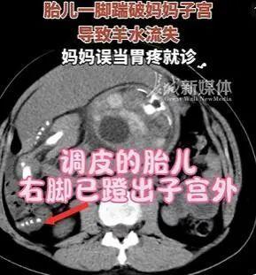 胎儿“无影脚”蹬出子宫外