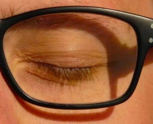 眼睑异常能治愈吗 怎么判断自己眼睛凸