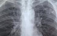 肺结核的早期症状 怎样治疗肺结核