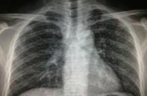 肺结核是怎样引起的 肺结核的症状都有什么
