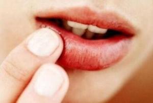 什么是唇炎 唇炎的症状有哪些