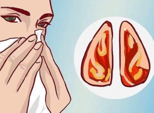 小孩过敏性鼻炎 小孩过敏性鼻炎怎么办