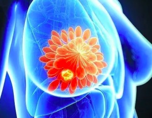 治疗乳腺癌患者的方法有哪些 乳腺癌骨转移的治疗方法有哪些
