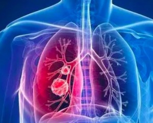 肺癌患者胸前积液所致呼吸困难如何缓解 肺癌患者出现不适的护理要点