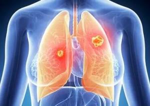 晚期肺癌的治疗方法都有什么 肺癌的治疗中的注意事项需要认清相关知识