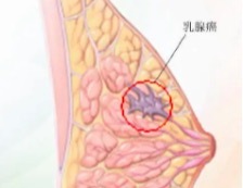女性乳腺癌治疗方法有哪些 早期乳腺癌保乳手术怎么切