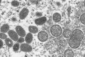 瑞典发现首例猴痘病例