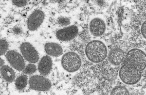 已出現人際傳播，猴痘會大流行嗎？