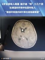 女童发烧17天脑子险被霉菌“啃”空 烟曲霉菌成真凶
