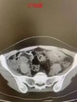 女子误吞一次性筷子小竹片 吃饭玩手机酿大祸
