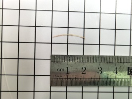 女子腹部“隐痛”一个月，元凶竟是一根鱼刺