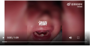 早产儿出生罕见长2颗牙 医生怕宝宝呛到气管，建议他们拔掉