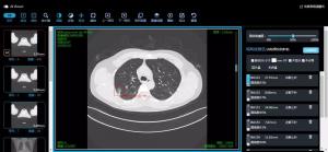 肺结节AI检测系统在京投用 2分钟精准识别，早期筛查准确率超80%