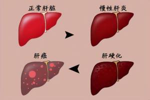 肝硬化并不是毫无预兆，若有这几个异常赶紧上医院，早了解早预防 警惕肝脏“沉默杀手”