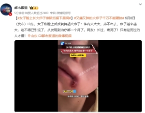 女子臉上長火癤子排膿后留下黑洞 網(wǎng)友：只有經(jīng)歷過的人才懂