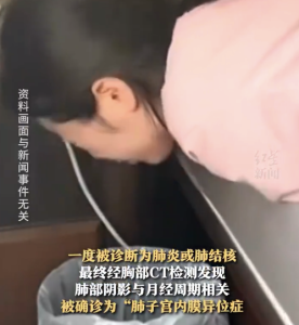 女孩經(jīng)期咳血查出子宮內(nèi)膜逃到肺部 醫(yī)生提醒經(jīng)期咳血胸痛應(yīng)盡早就診