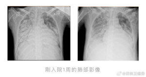 小伙高燒不退肺被“燒白”進ICU,，感染超級耐藥菌差點沒命,！