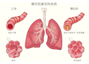 關(guān)于肺癌的8大錯(cuò)誤認(rèn)知,，你了解多少,？
