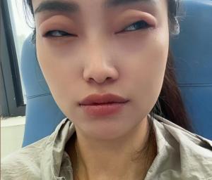 2顆楊梅下肚 女子眼睛差點看不見了 罕見過敏案例警示